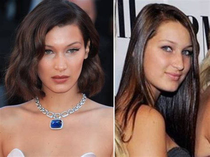 Bella Hadid Before and After Plastic Surgery Including Nose Job and