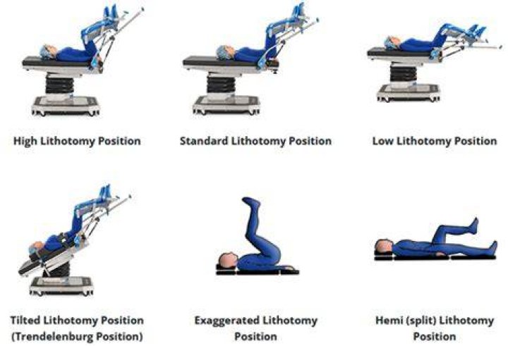 Exploration In Lithotomy Position And Two Other Very Important Variants