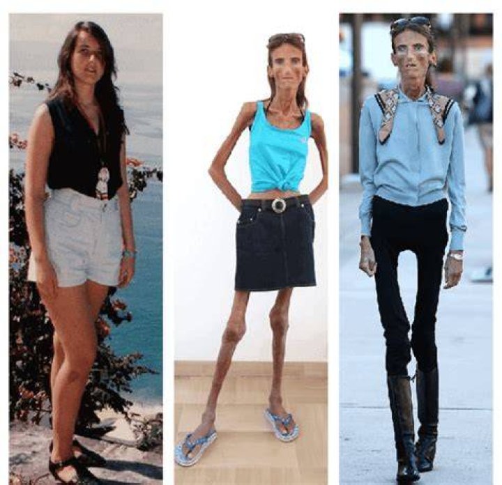 How much does the skinniest person in the world weigh?