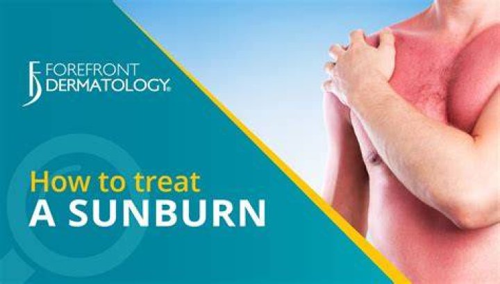 How to Properly Treat Sunburn & How to Prevent It in Australia