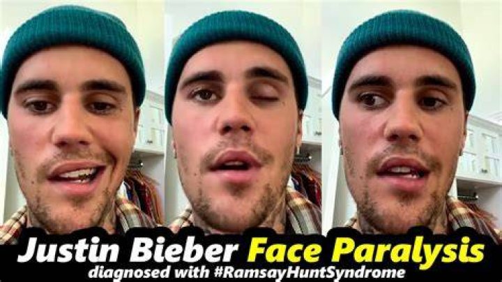 Justin Bieber&rsquo;s face paralysis &mdash; what is Ramsay Hunt syndrome?