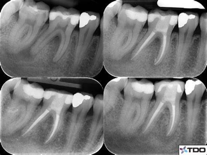 Large PARL Healing after Orthograde Endodontic Treatment Australian