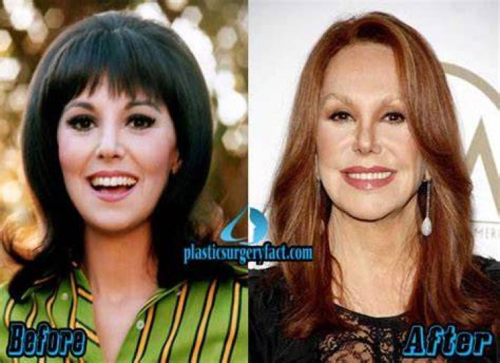 Marlo Thomas Plastic Surgery Before and After Photos