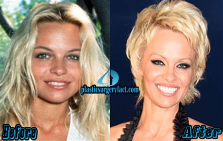 Pam Anderson Facelift Surgery- Before And After Photos ·