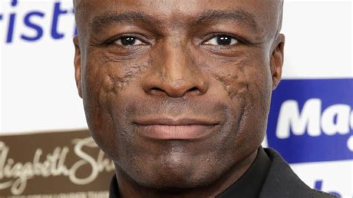 Seal says facial scars are caused by lupin, which he got when he was 21