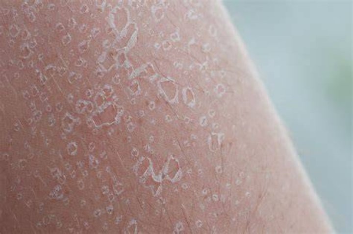 Sunburn Oops. Light sunburn on my arm. Here are the effect&hellip; Flickr