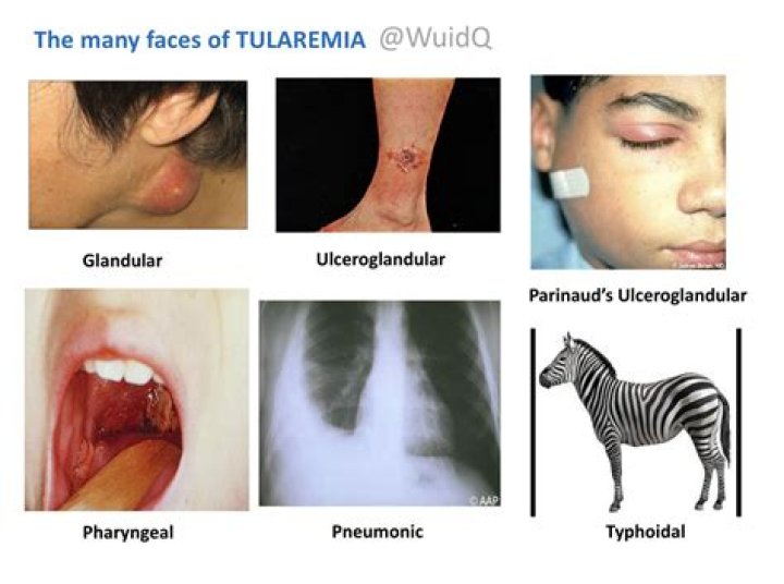 The Many Faces of Tularemia • Glandular • Ulceroglandular GrepMed