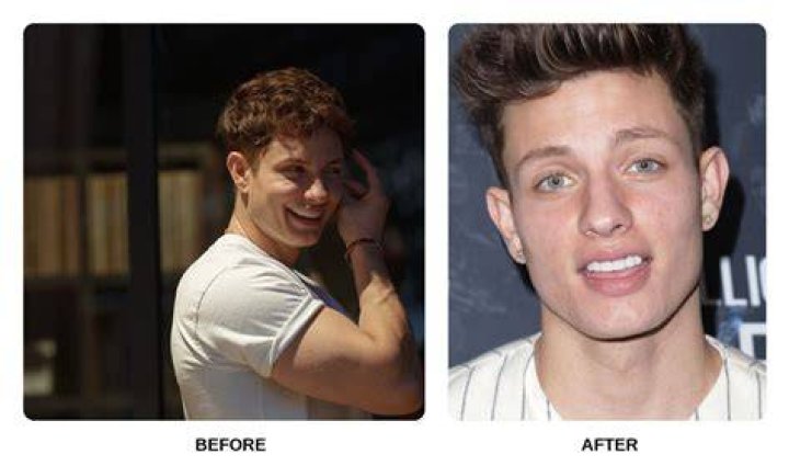 Unveiling The Enigma Of Matt Rife's Bad Teeth: Surprising Revelations