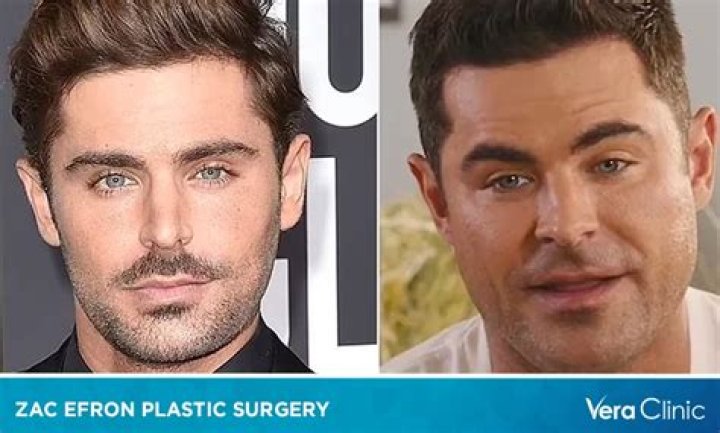Unveiling The Secrets Of Zac Efron's Plastic Surgery Journey