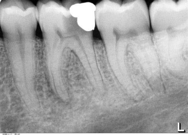 What is a periapical radiolucency? Perio Implant Advisory